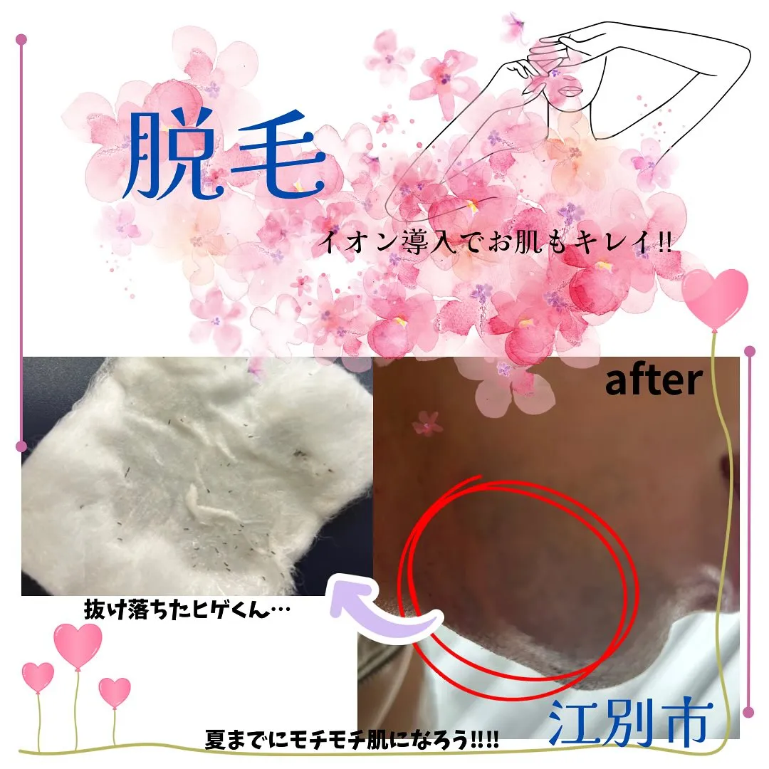 【ヒゲ脱毛経過】