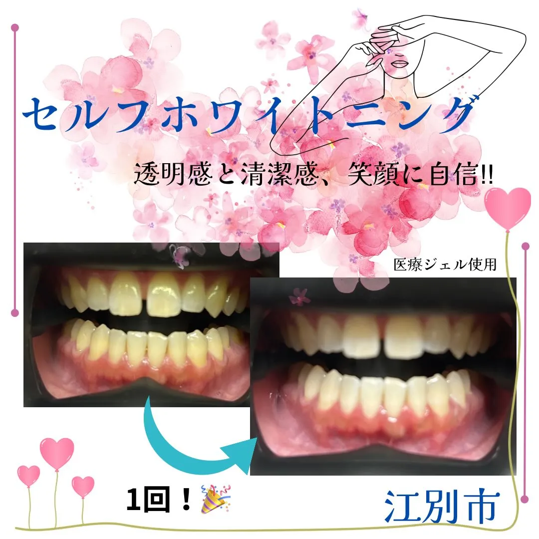 ＼セルフホワイトニングで“うるつや白さ”へ✨／