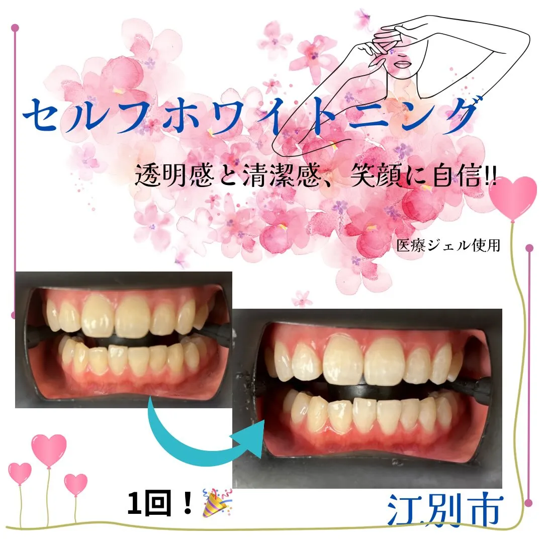 歯科に負けないセルフホワイトニング🌟